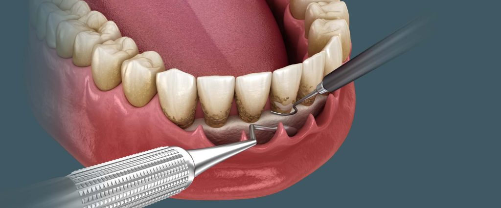 גורמים לנסיגת חניכיים והטיפול בו