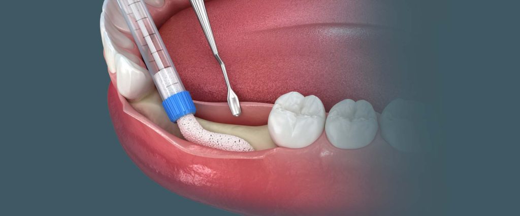 טיפול פריודונטאלי כירורגי