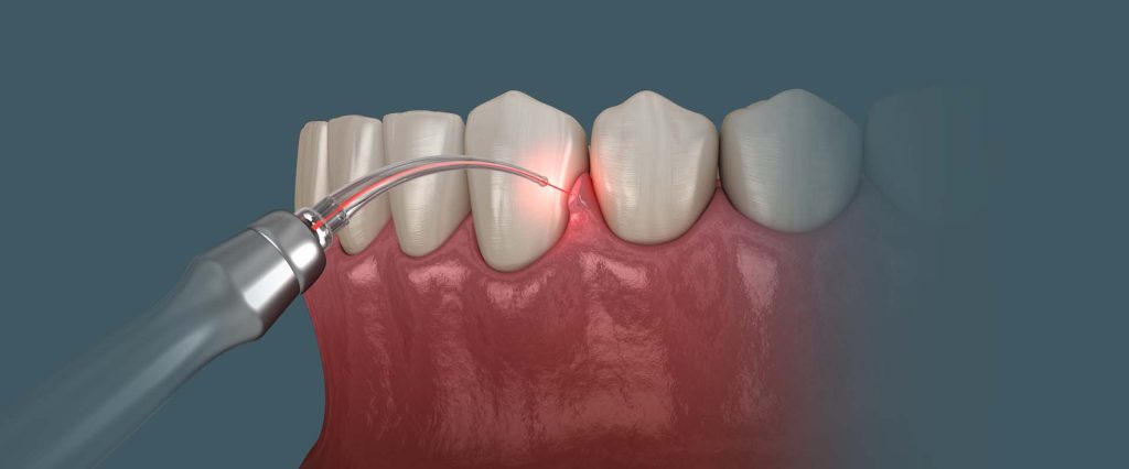 טיפול פריודנטאלי לא כירורגי