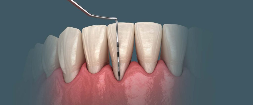 פריודונט ובדיקת חניכיים